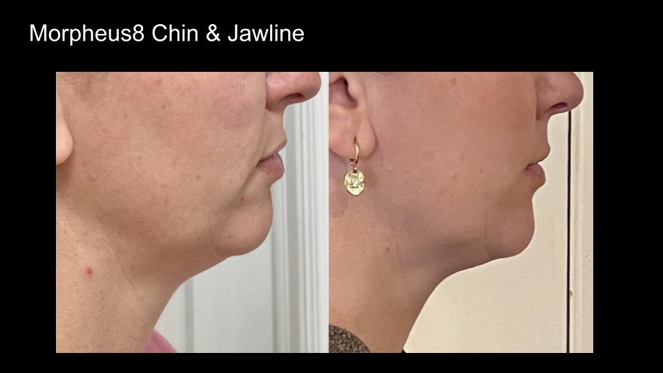 B&A M8 Chin, Jaawline