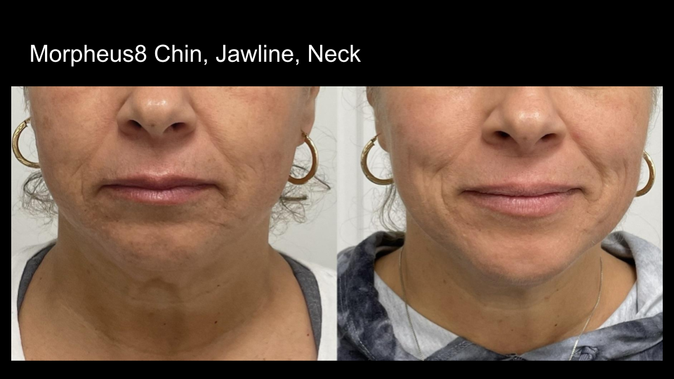 B&A M8 Chin, Jawline, Neck