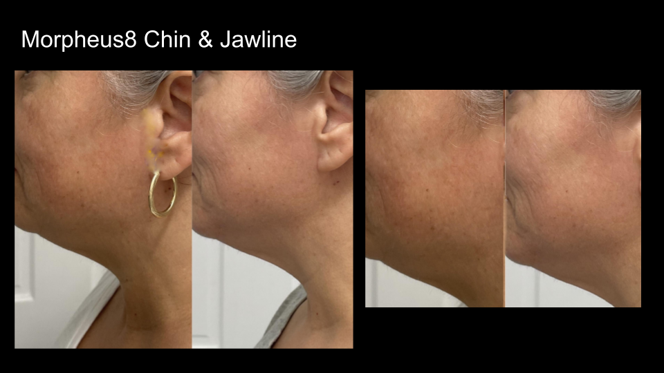 B&A M8 Chin & Jawline
