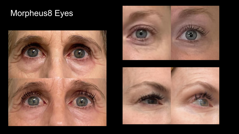 B&A M8 Eyes3