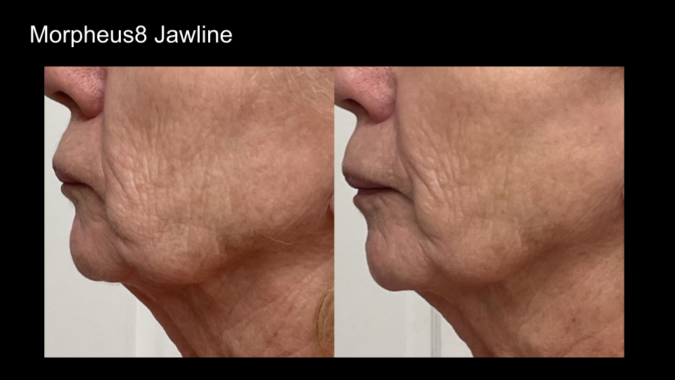 B&A M8 Jawline