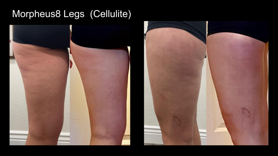 B&A M8 Legs