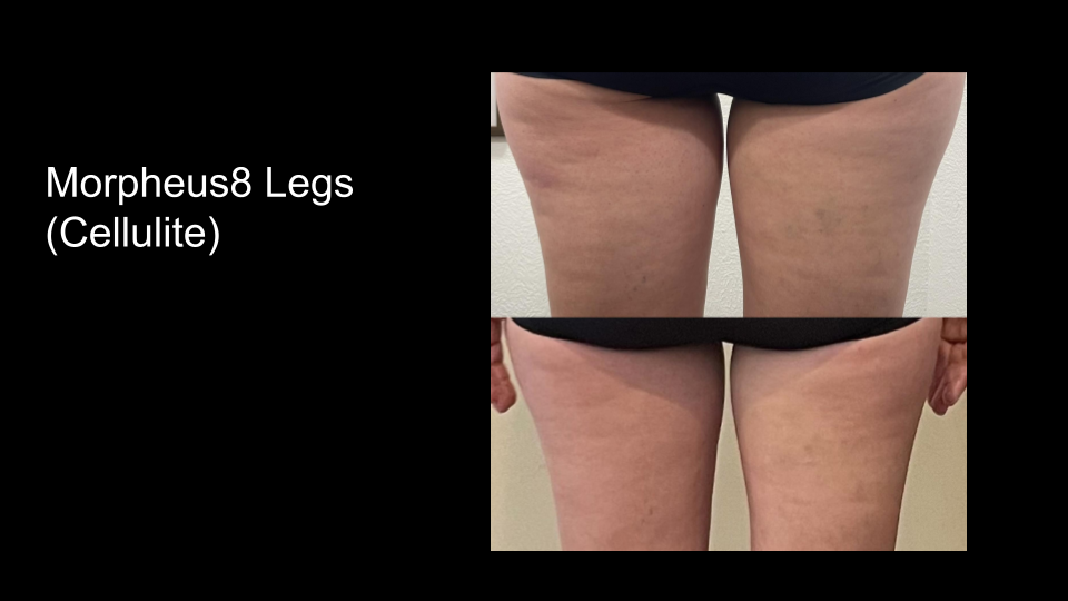 B&A M8 Legs2