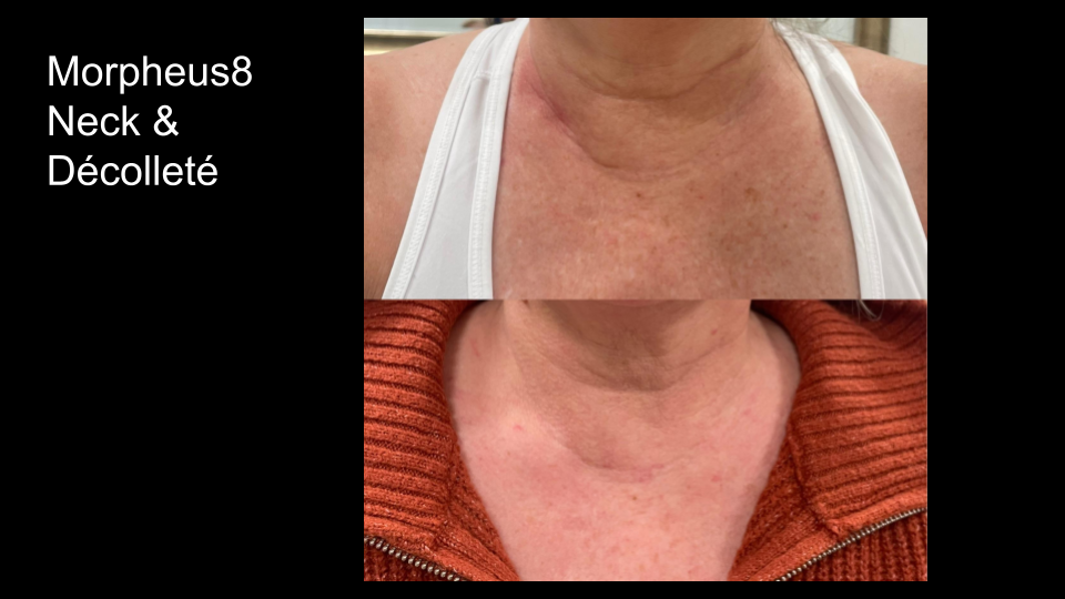 B&A M8 Neck & Decollete