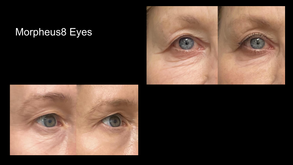 B&A M8 eyes2