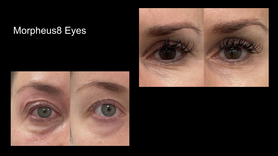 Before and After photos Morpheus8