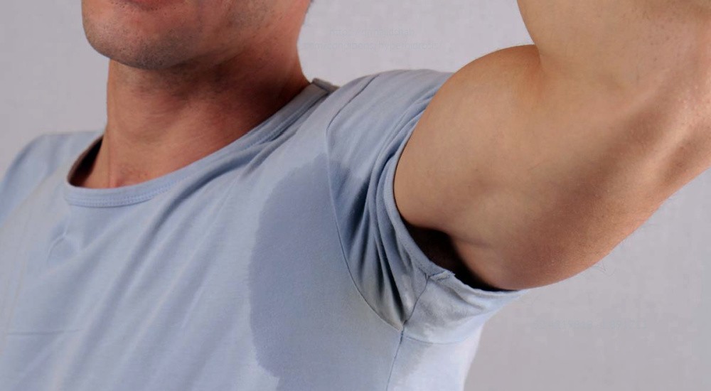hyperhidrosis