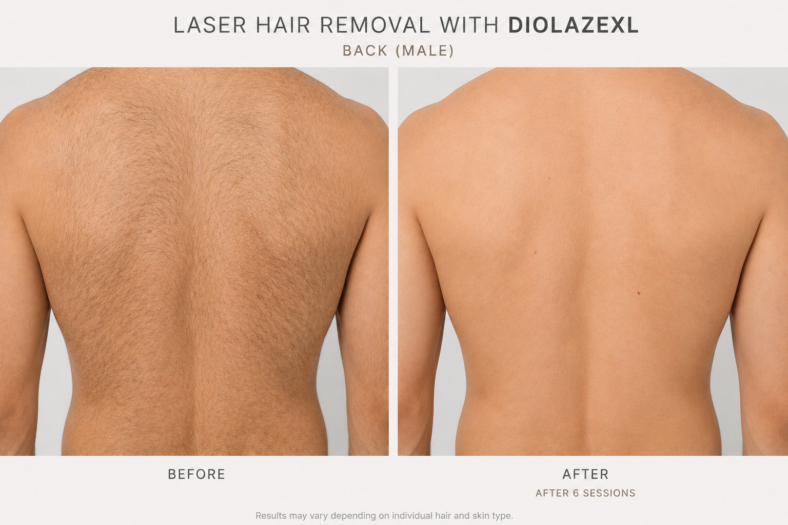 B&A Laser back