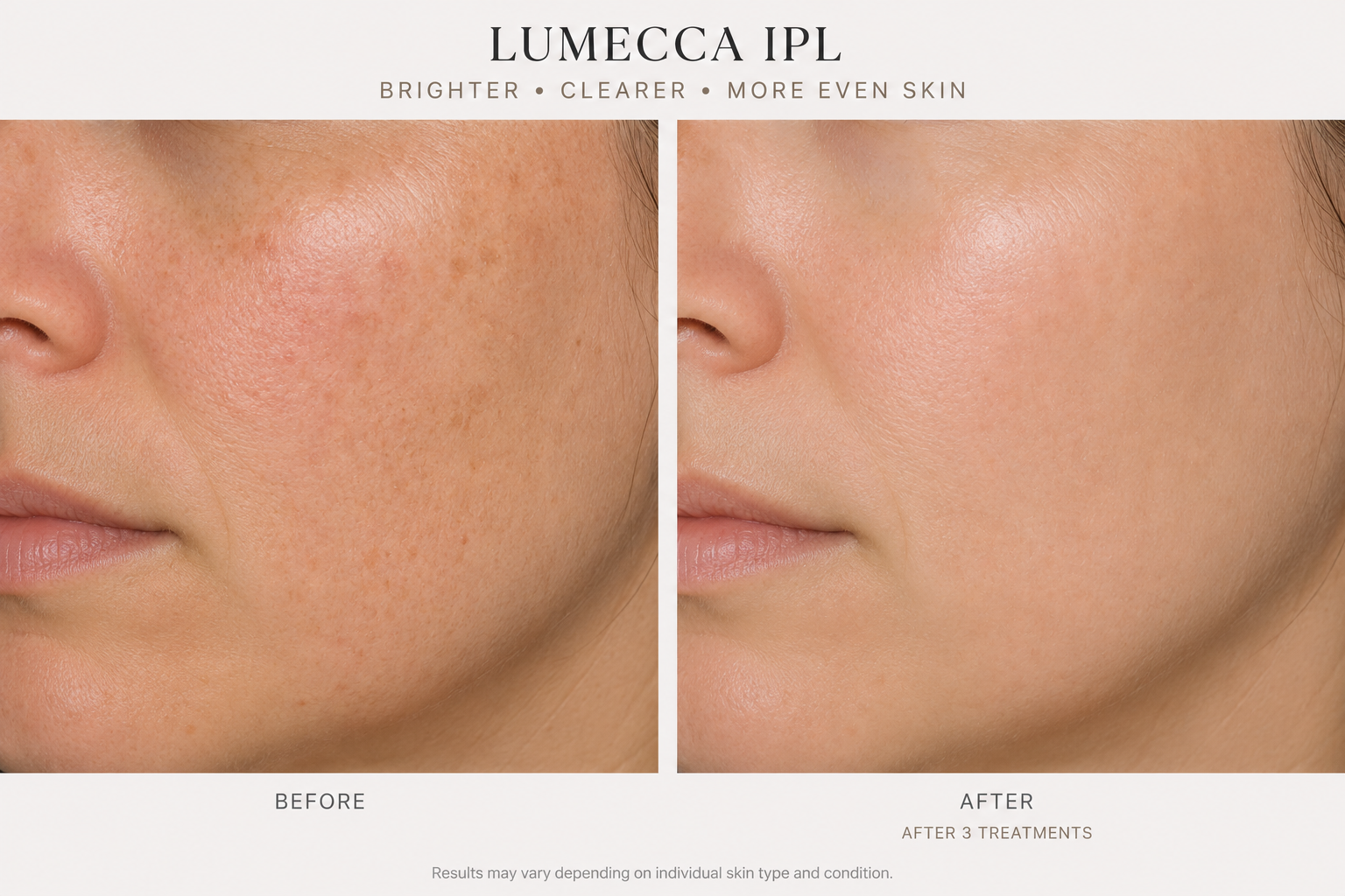 Lumecca IPL b&A