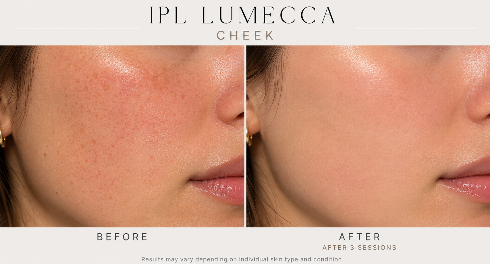 LumeccaIPL b&a