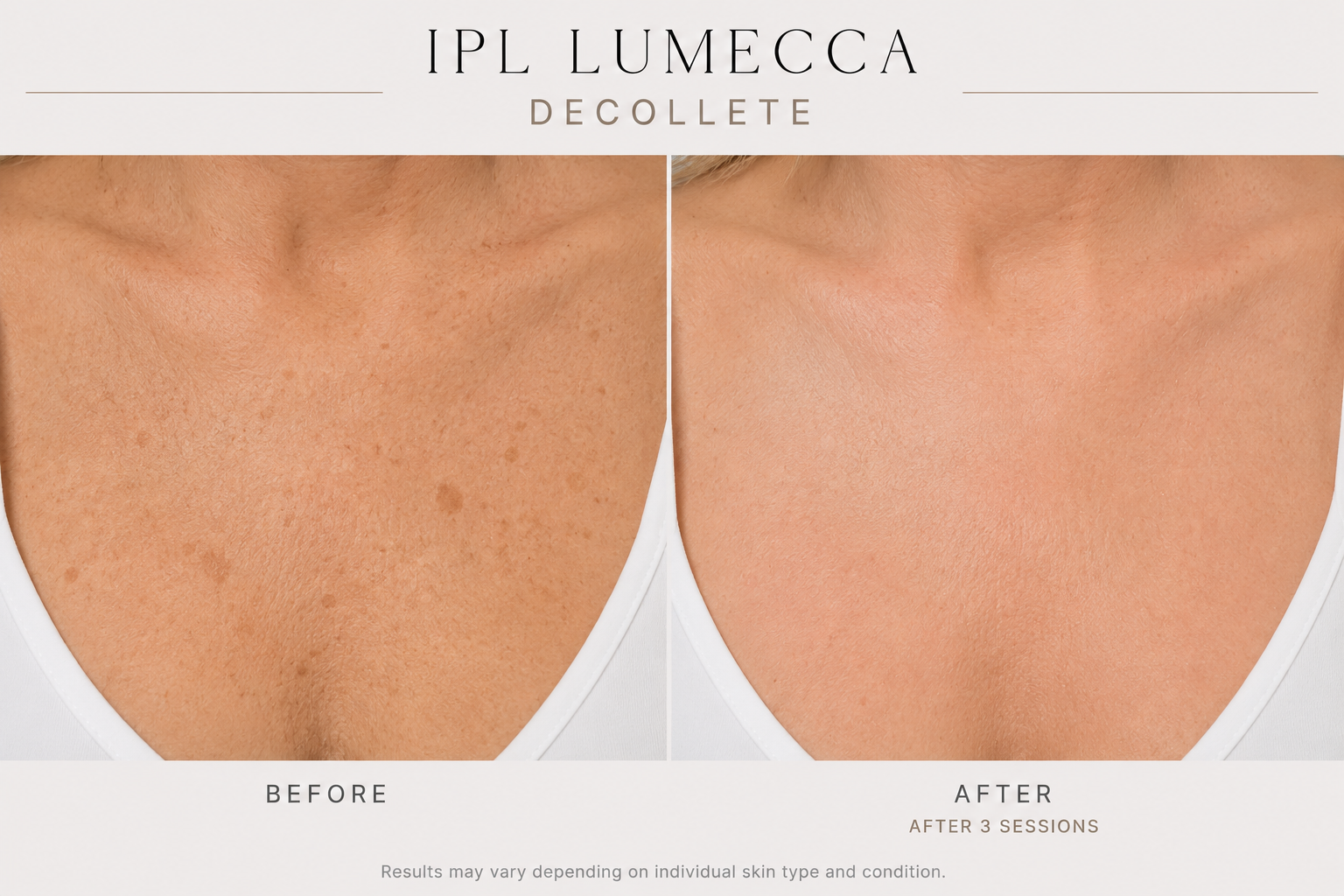 Lumeccaipl chest b&A