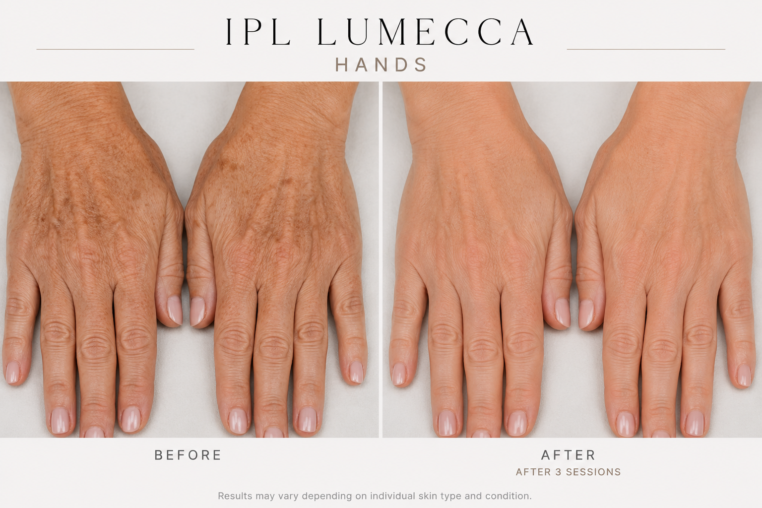 LummecaIPL hands